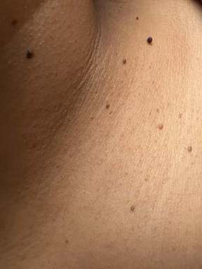 skin tag 2.jpg