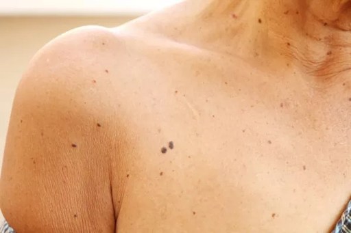 skin tag 4.jpg